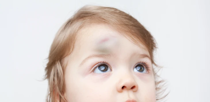 Child Fell and Hit Their Head