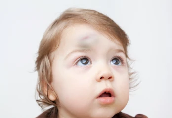 My Child Fell and Hit Their Head – When Should I See a Doctor?